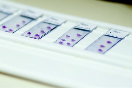 15. Tumour slides